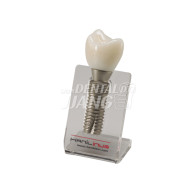 Single Implant Model #HL-60047